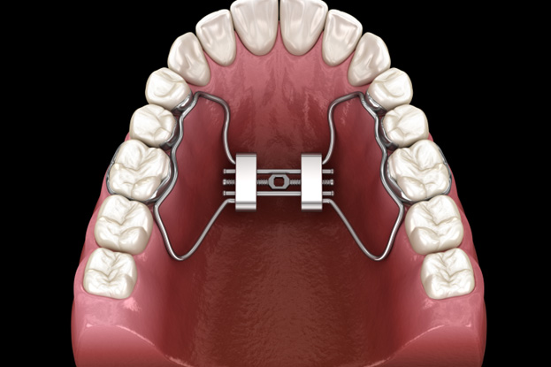 Illustration of a palatal expander on the roof of the mouth