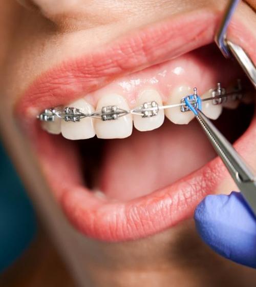 Close up of a patient having their braces adjusted by Blue Cross Blue Shield orthodontist