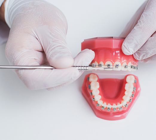 Gloved hands holding a model of the mouth with braces