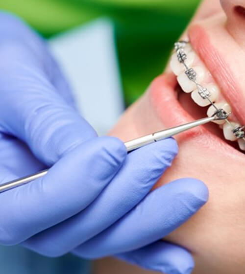 Gloved hand using instrument on orthodontic patients braces