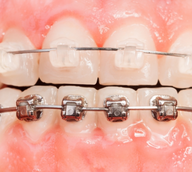 Illustration of teeth with half metal brackets, half clear brackets