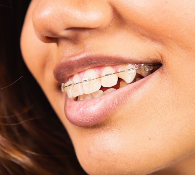 Man in scrubs holding clear aligners