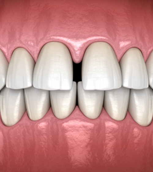 Illustration of teeth with gap between the two front incisors