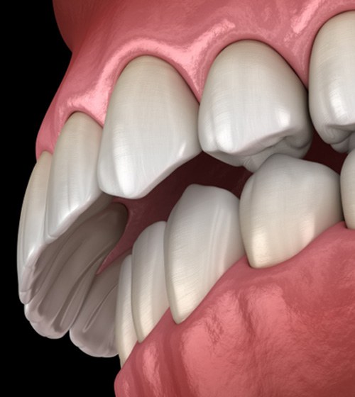 Close up illustration of mouth with overbite against dark background