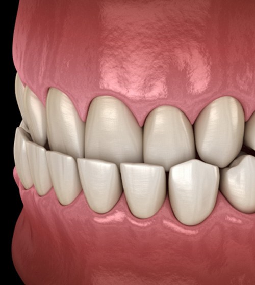 Close up illustration of mouth with underbite against dark background