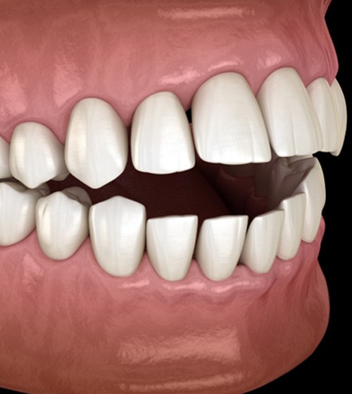 Illustration of mouth with significant open bite against dark background