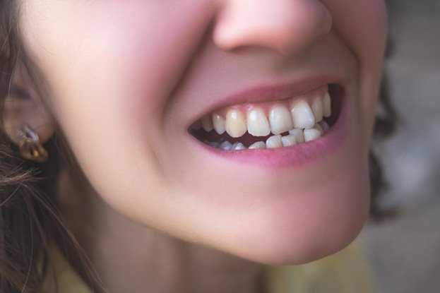 close up of person smiling with crowded teeth