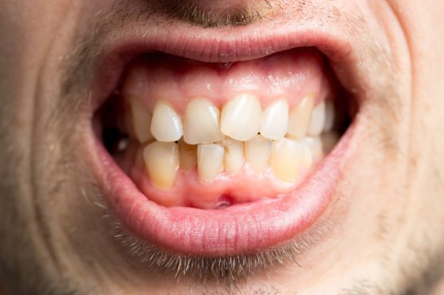 close up of a mouth with crowded teeth