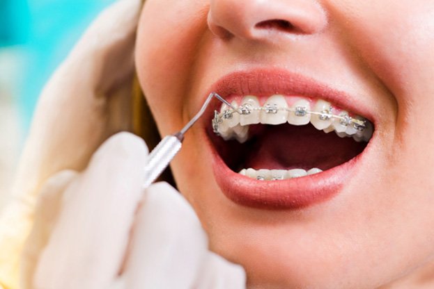 Close up of a patient getting braces