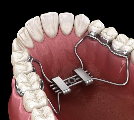 a 3D illustration of a palatal expander