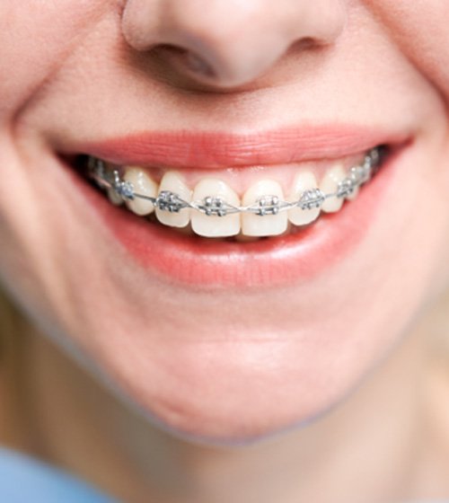 Close up of a person with braces smiling after seeing Met Life orthodontist in Allen