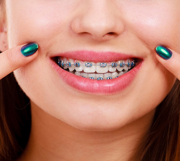 Close up of woman with braces pointing to her smile