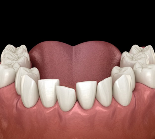 Illustrated row of unevenly spaced lower teeth