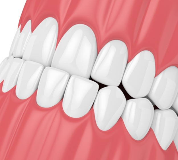 Illustration of a mouth with a slight underbite