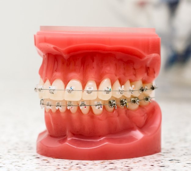 Model of the teeth with traditional braces resting on a table