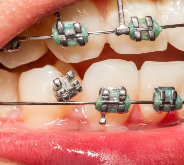 Close up of a mouth with braces and a broken bracket