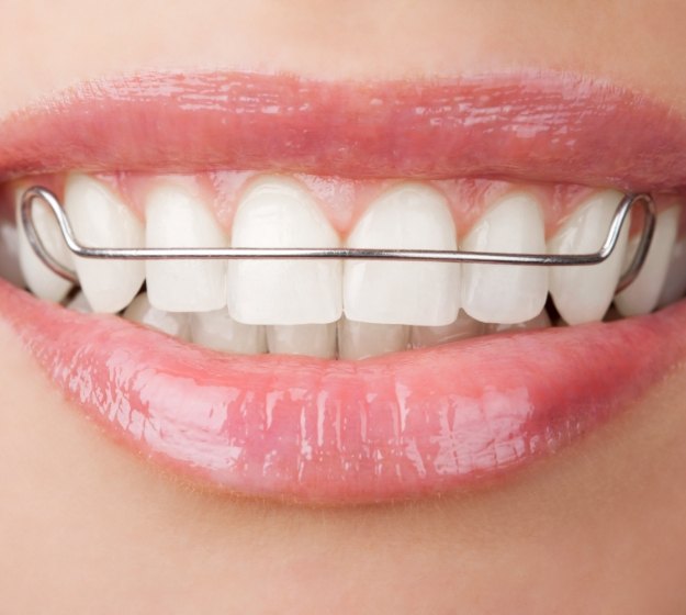 Close up of a mouth wearing a wire retainer