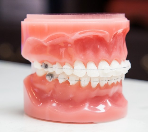 Model of the teeth with clear ceramic braces