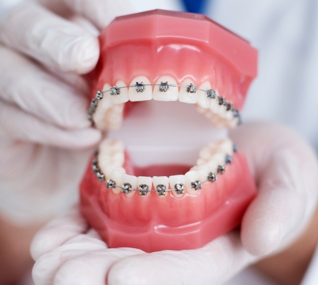 Orthodontist holding a model of the mouth with self ligating braces in Allen