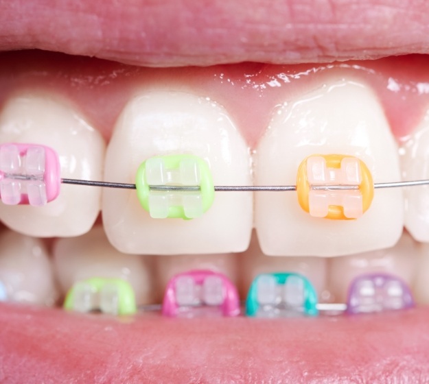 Close up of mouth with braces and different colored brackets