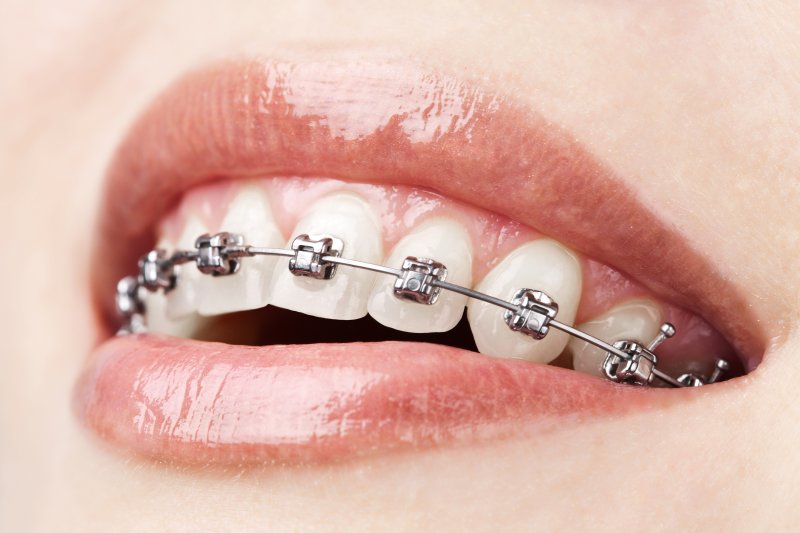 up-close view of metal braces